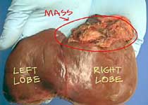 hepatoblastoma with annotations