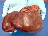 hepatoblastoma