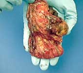 neuroblastoma
